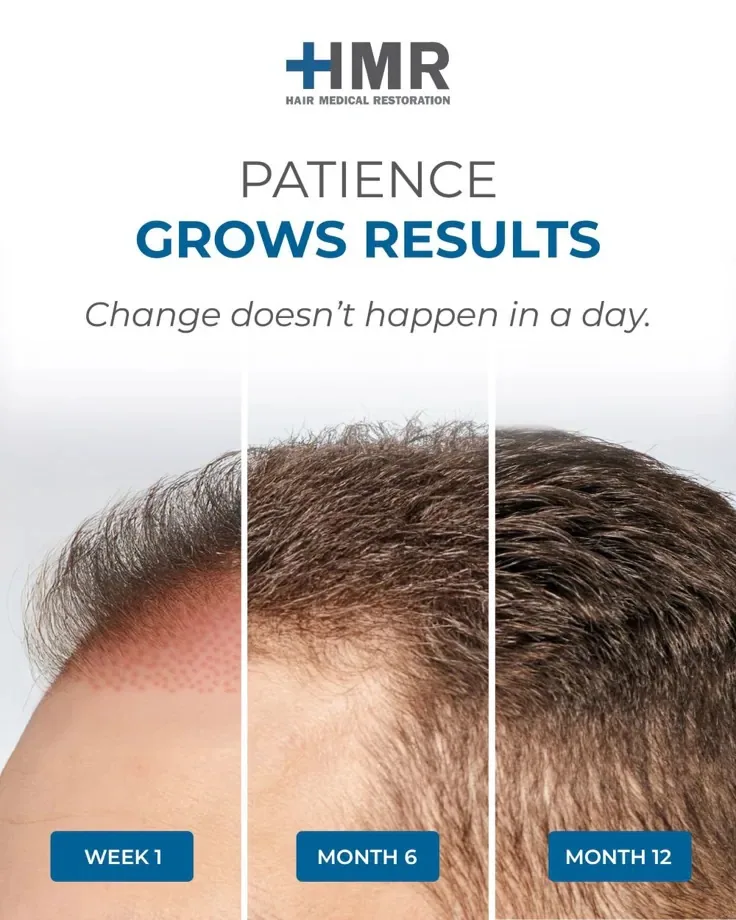 Three-stage hair-growth timeline